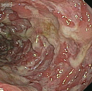 Inflammatory Bowel Disease